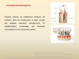 Historia implantów stomatologicznych