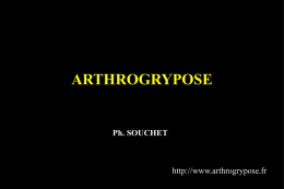 ARTHROGRYPOSE