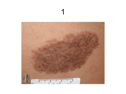 Pigmented Skin Lesions