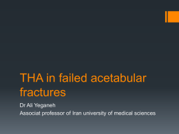 THA in failed acetabular fractures