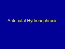 Antenatal Hydronephrosis