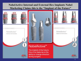 NobelActive Internal and External Hex Implants Nobel