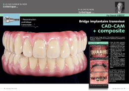 Bridges CAD CAM composite - Laboratoire Benoit Gobert