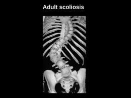 Adult scoliosis