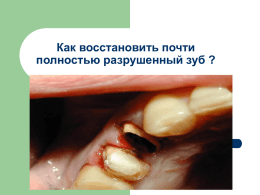 Как восстановить почти полностью разрушенный зуб ? Ольга: У меня сломался зуб.