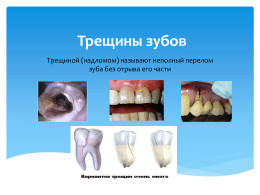 Трещины зубов Трещиной (надломом) называют неполный перелом зуба без отрыва его части   Причины возникновения трещин: У витальных зубов:  травма;  парафункции;  ятрогенный фактор   У девитальных зубов.