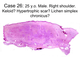 Case 26: 25 y.o. Male. Right shoulder. Keloid? Hypertrophic scar? Lichen simplex chronicus?       On examination On Examination • Approximately 5x4cm dermal nodule • Firm texture • right shoulder •