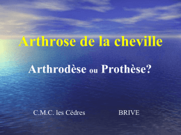 Arthrodése - Clinique des Cèdres Orthopédie Brive