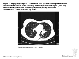 Figur 2 Høgoppløysings-CT av thorax tatt før behandlingsstart viser multiple små noduli med tilfeldig distribusjon i båe lunger (kvit pil), konsolidering i.