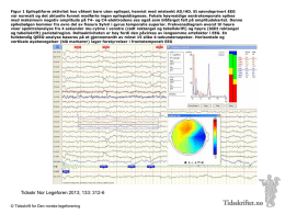 Figur 1 Epileptiform aktivitet hos våkent barn uten epilepsi, henvist med mistenkt AD/HD.