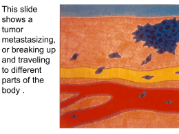 This slide shows a tumor metastasizing, or breaking up and traveling to different parts of the body .