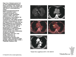 Figur 3a–e Pasient med et 2,3 cm stort plateepitelkarsinom i høyre overlapp i nær relasjon til mediastinum ble undersøkt med 18F-fluoro-2-deoksyglukose (FDG)positronemisjonstomografi (PET) kombinert med computertomografi (CT) i.