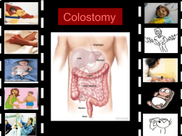 Colostomy WHAT IS STOMA It is an artificial opening from the intestine on the abdominal wall usually created by a surgeon.
