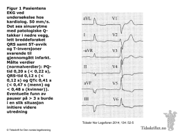 Figur 1 Pasientens EKG ved undersøkelse hos kardiolog. 50 mm/s. Det ses sinusrytme med patologiske Qtakker i nedre vegg, lett breddeforøket QRS samt ST-avvik og T-inversjoner svarende til gjennomgått infarkt. Målte.