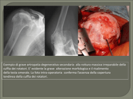 Esempio di grave artropatia degenerativa secondaria alla rottura massiva irreparabile della cuffia dei rotatori.