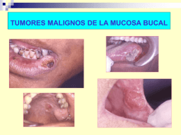 TUMORES MALIGNOS DE LA MUCOSA BUCAL Tumores Malignos Clasificación  Tumores  m. epiteliales.  Tumores m.