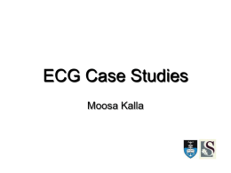 ECG Case Studies Moosa Kalla Case 1 • • • • • • •  52 yr old man No Hx of IHD Known HPT on Rx Presents with acute onset chest Initial ECG.