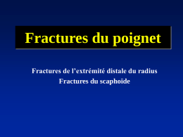 Fractures du poignet Fractures de l’extrémité distale du radius Fractures du scaphoïde.