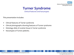 Turner Syndrome Clinical features and karyotypes This presentation includes:  • • • •  Clinical features of Turner syndrome Clinical photographs showing features of Turner syndrome Histology slide of ovarian.