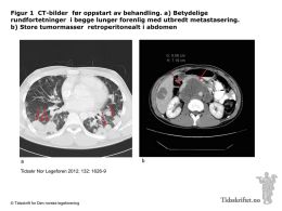 Figur 1 CT-bilder f&oslash;r oppstart av behandling. a) Betydelige rundfortetninger i begge lunger forenlig med utbredt metastasering. b) Store tumormasser retroperitonealt i.