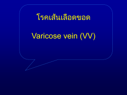 โรคเส้นเลือดขอด Varicose vein (VV) Symptom • Pain • Cramp • Cosmetic problem  Complication • Hyperpigmentation of skin • Thrombophebitis • Bleeding • Ulcer.