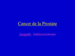 Cancer de la Prostate Anapath : Adénocarcinome